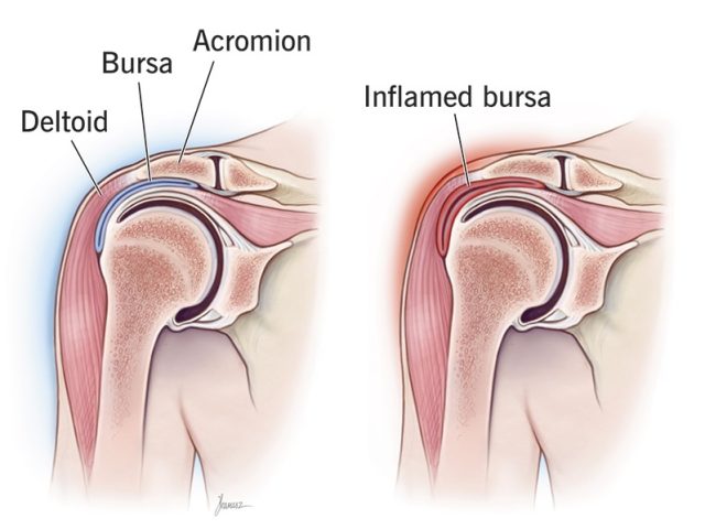 Remedial massage therapist treating a client's shoulder for bursitis at Sparkle Massage Hobart