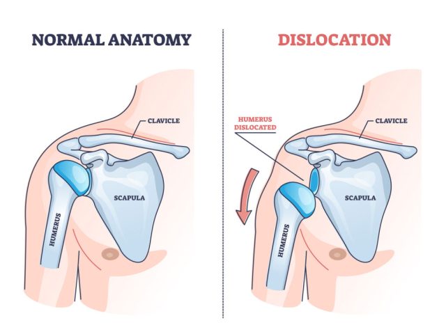 dislocated shoulder